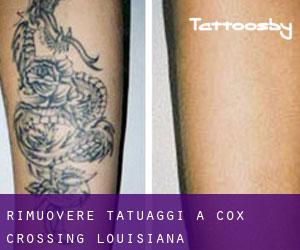 Rimuovere Tatuaggi a Cox Crossing (Louisiana)