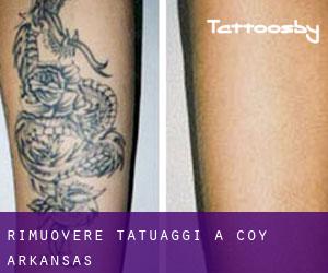 Rimuovere Tatuaggi a Coy (Arkansas)