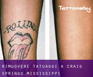 Rimuovere Tatuaggi a Craig Springs (Mississippi)