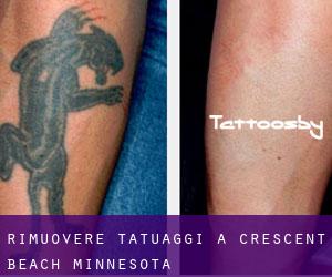 Rimuovere Tatuaggi a Crescent Beach (Minnesota)