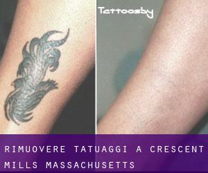 Rimuovere Tatuaggi a Crescent Mills (Massachusetts)