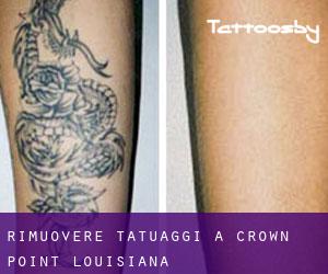 Rimuovere Tatuaggi a Crown Point (Louisiana)