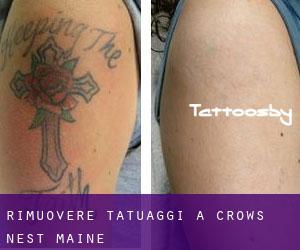 Rimuovere Tatuaggi a Crows Nest (Maine)