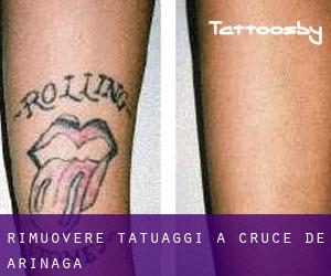 Rimuovere Tatuaggi a Cruce de Arinaga