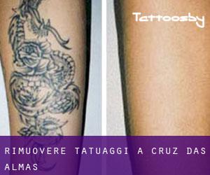 Rimuovere Tatuaggi a Cruz das Almas