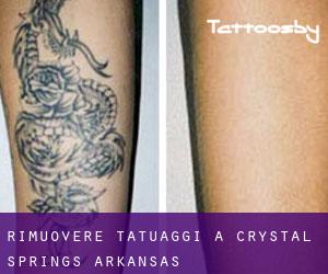 Rimuovere Tatuaggi a Crystal Springs (Arkansas)