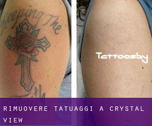 Rimuovere Tatuaggi a Crystal View
