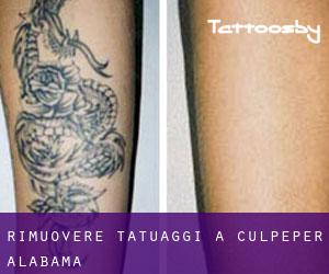 Rimuovere Tatuaggi a Culpeper (Alabama)