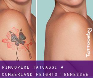 Rimuovere Tatuaggi a Cumberland Heights (Tennessee)