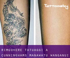 Rimuovere Tatuaggi a Cunninghams (Manawatu-Wanganui)