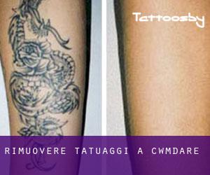 Rimuovere Tatuaggi a Cwmdare