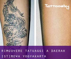 Rimuovere Tatuaggi a Daerah Istimewa Yogyakarta