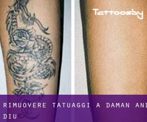 Rimuovere Tatuaggi a Daman and Diu