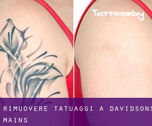 Rimuovere Tatuaggi a Davidsons Mains