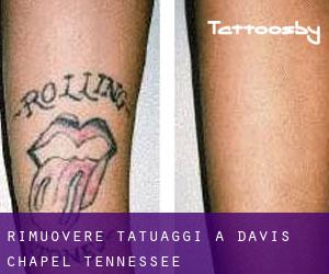 Rimuovere Tatuaggi a Davis Chapel (Tennessee)