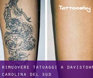 Rimuovere Tatuaggi a Davistown (Carolina del Sud)