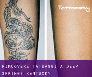 Rimuovere Tatuaggi a Deep Springs (Kentucky)