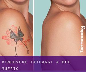 Rimuovere Tatuaggi a Del Muerto