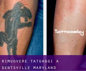 Rimuovere Tatuaggi a Dentsville (Maryland)