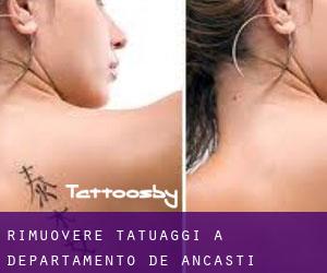 Rimuovere Tatuaggi a Departamento de Ancasti