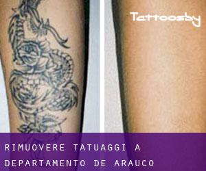 Rimuovere Tatuaggi a Departamento de Arauco