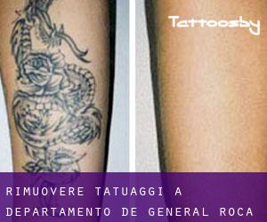 Rimuovere Tatuaggi a Departamento de General Roca
