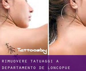 Rimuovere Tatuaggi a Departamento de Loncopué