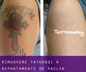 Rimuovere Tatuaggi a Departamento de Paclín