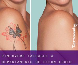 Rimuovere Tatuaggi a Departamento de Picún Leufú