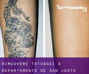 Rimuovere Tatuaggi a Departamento de San Justo