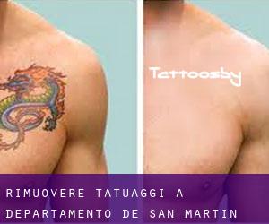 Rimuovere Tatuaggi a Departamento de San Martín