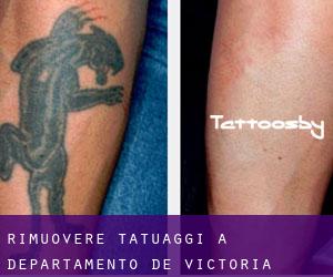Rimuovere Tatuaggi a Departamento de Victoria