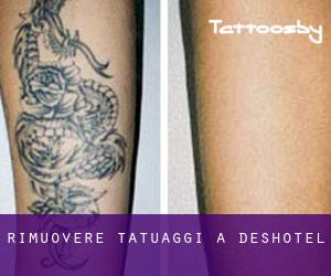 Rimuovere Tatuaggi a Deshotel