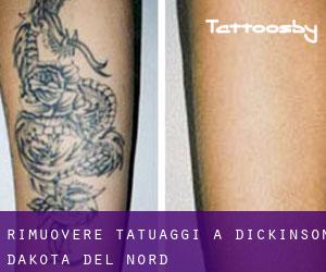 Rimuovere Tatuaggi a Dickinson (Dakota del Nord)