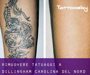Rimuovere Tatuaggi a Dillingham (Carolina del Nord)