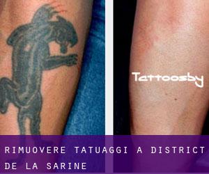 Rimuovere Tatuaggi a District de la Sarine