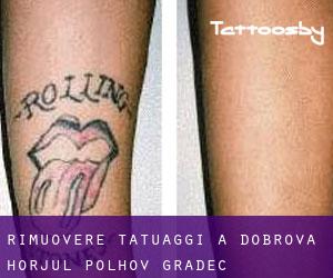 Rimuovere Tatuaggi a Dobrova-Horjul-Polhov Gradec