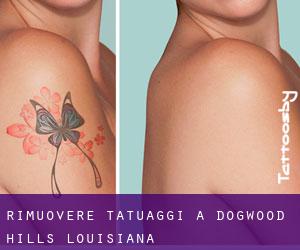Rimuovere Tatuaggi a Dogwood Hills (Louisiana)