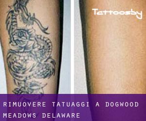 Rimuovere Tatuaggi a Dogwood Meadows (Delaware)