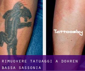 Rimuovere Tatuaggi a Dohren (Bassa Sassonia)