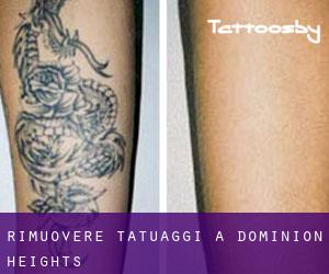 Rimuovere Tatuaggi a Dominion Heights