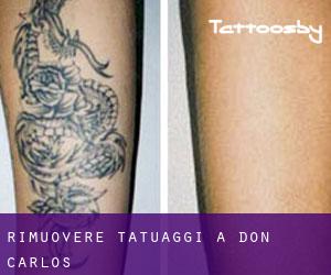 Rimuovere Tatuaggi a Don Carlos