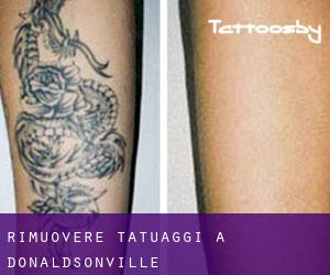 Rimuovere Tatuaggi a Donaldsonville