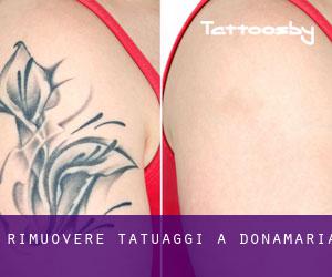 Rimuovere Tatuaggi a Donamaria
