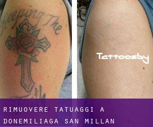 Rimuovere Tatuaggi a Donemiliaga / San Millán