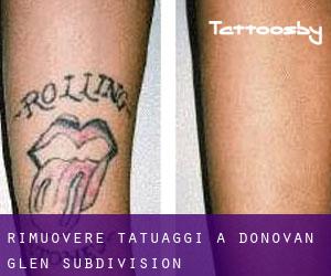 Rimuovere Tatuaggi a Donovan Glen Subdivision