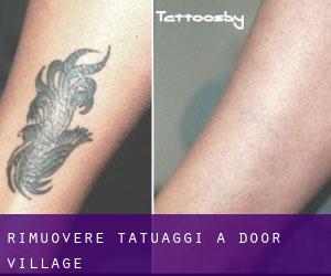 Rimuovere Tatuaggi a Door Village