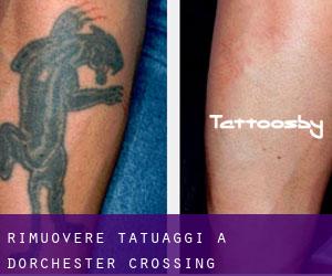 Rimuovere Tatuaggi a Dorchester Crossing