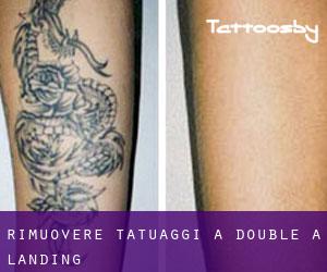 Rimuovere Tatuaggi a Double A Landing