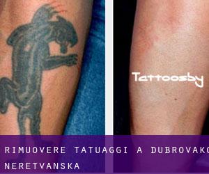 Rimuovere Tatuaggi a Dubrovačko-Neretvanska